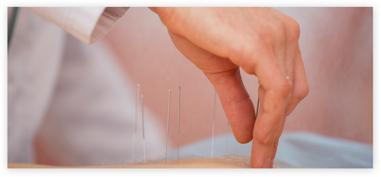 Acupuncture 针灸